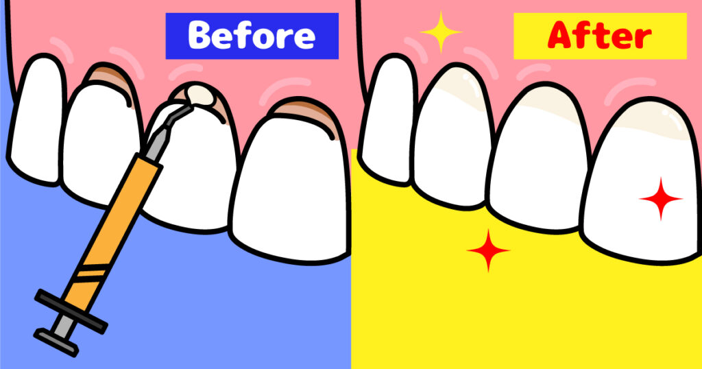 院長ブログ ~くさび状欠損について~ | 大阪市阿倍野区の歯科・歯医者|足立歯科クリニック(土日も診療)