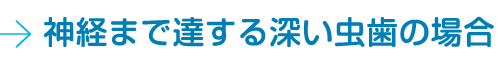 神経まで達する深い虫歯の場合