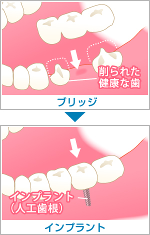 1本だけ歯をなくした場合