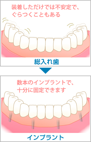 上顎または下顎の歯を全てなくした場合