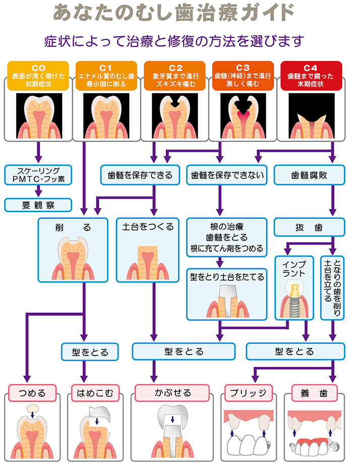 あなたの虫歯治療ガイド