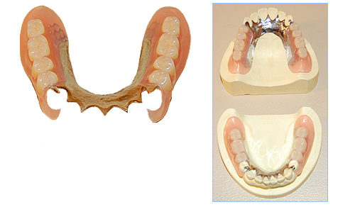 ノンクラスプデンチャー（バネのない入れ歯）