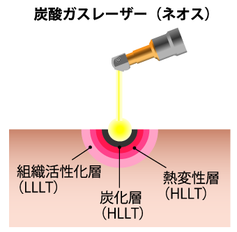 炭酸ガスレーザー（ネオス）