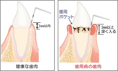 歯周ポケットとは？