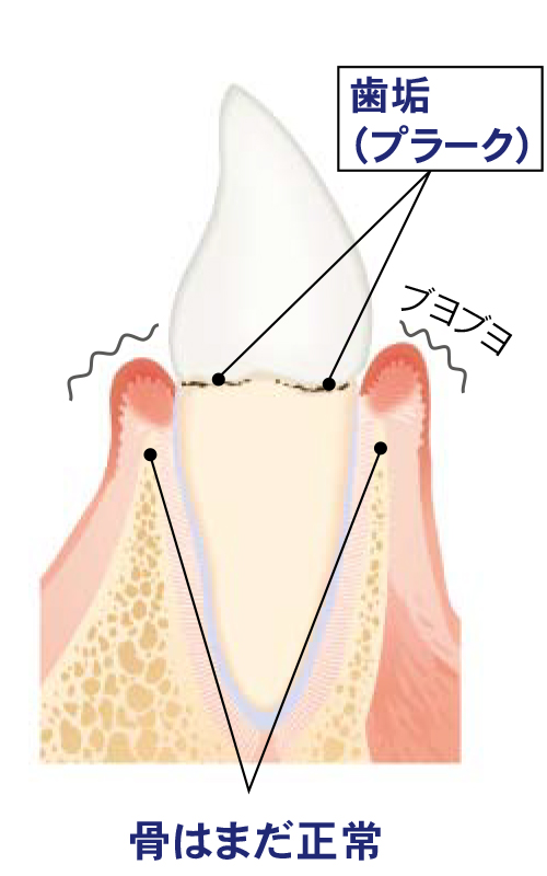 歯周炎
