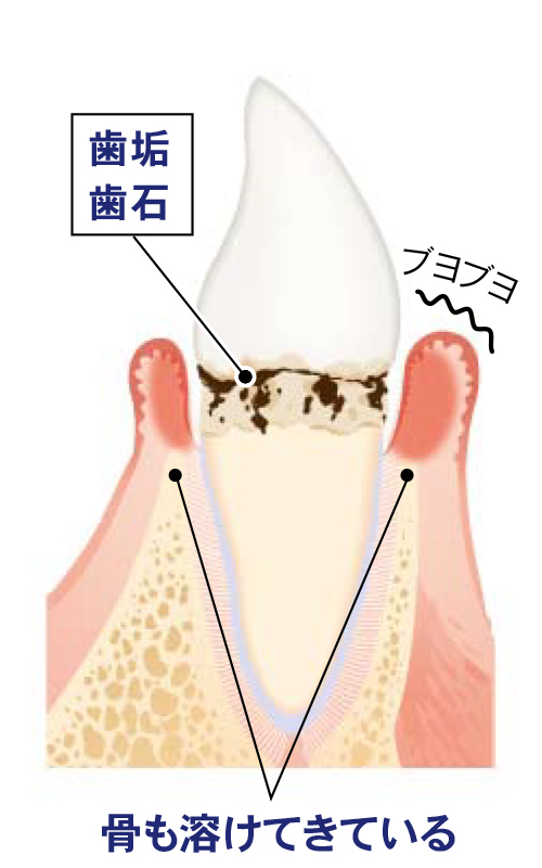 中等度歯周病