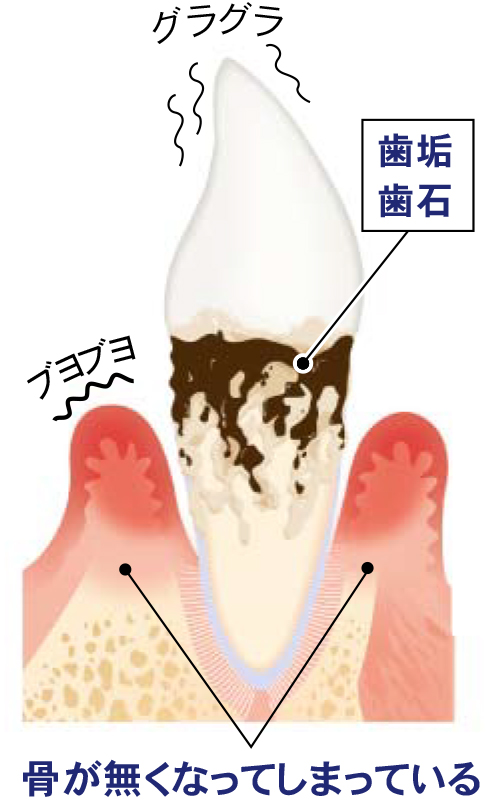 重度歯周病