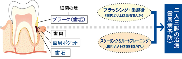 歯周ポケットの中の歯石を取り除きます